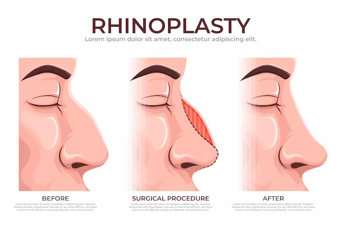 Rhinoplasty for Wide Nose: All You Need to Know